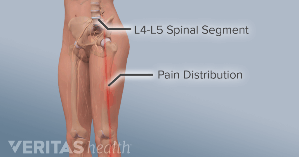 adult spine radiculopathy l4 l5