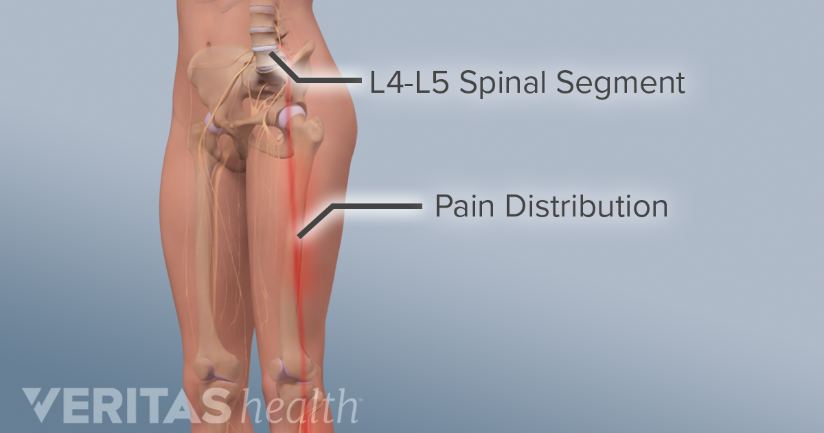 adult spine radiculopathy l4 l5